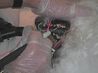 A Trinity tie holding a trach-tube firmly in place
